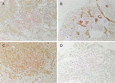 Expression of Components of the Renin-Angiotensin System in Pyogenic Granuloma